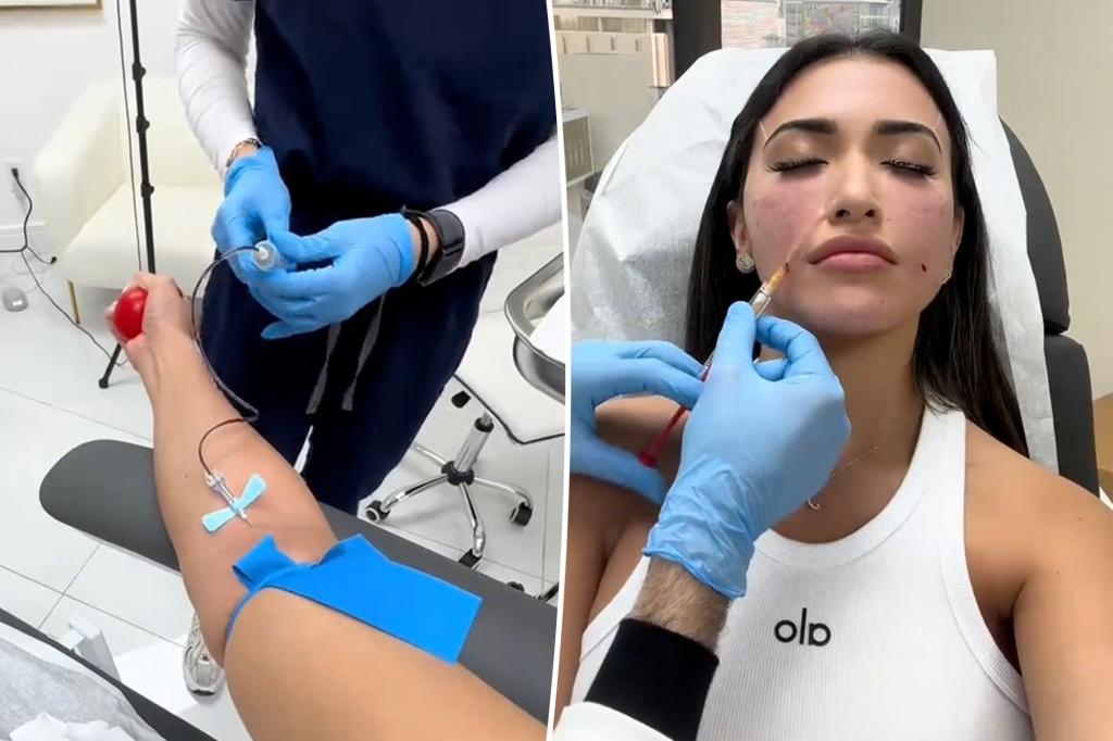 'Next-gen' filler craze uses your own blood, but docs warn it's 'unreliable'